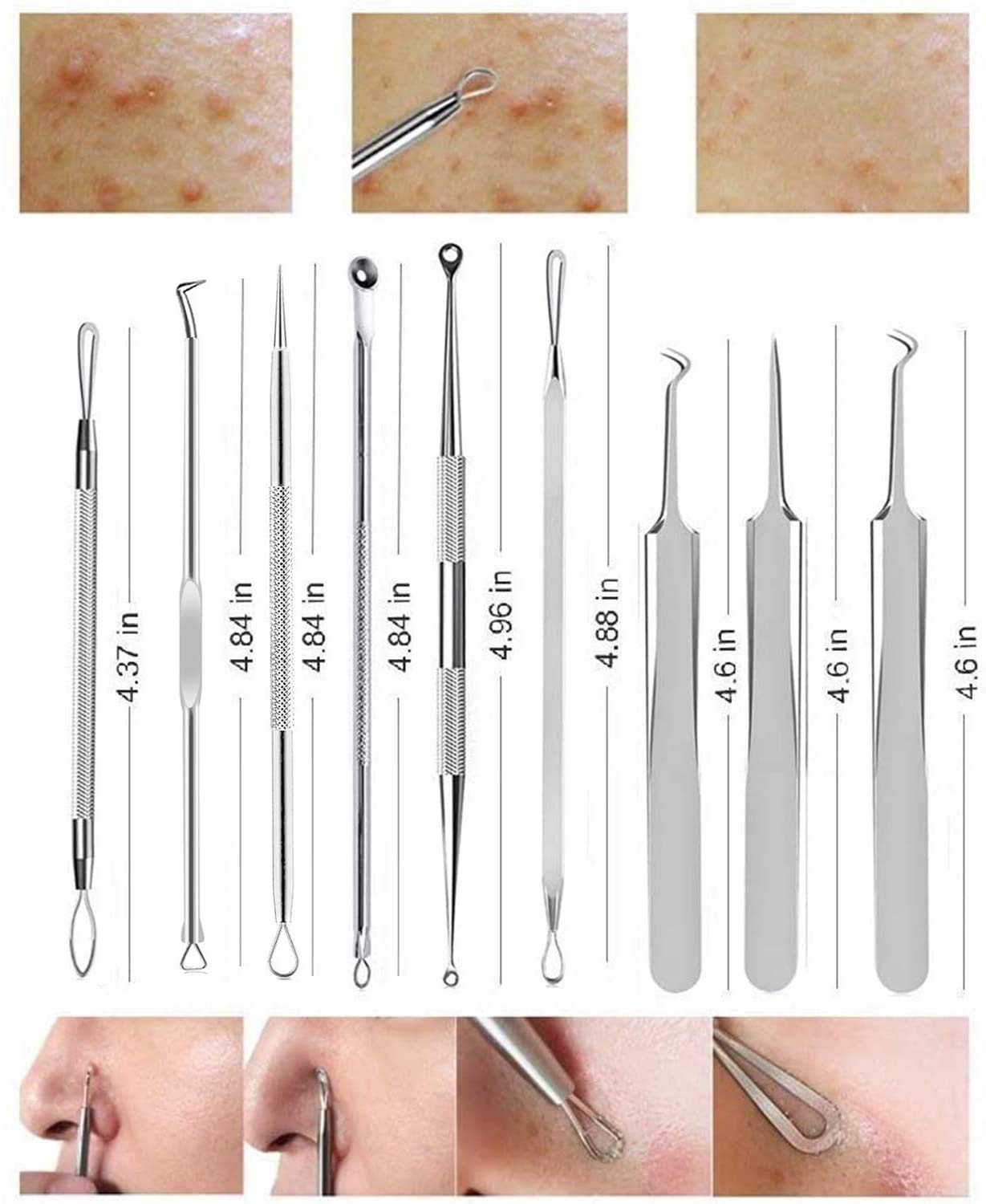 Pimple Popper Tool Kit Blackhead Remover With Pimple tweezers